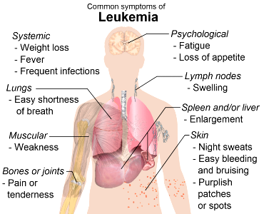 Symptoms of leukemia