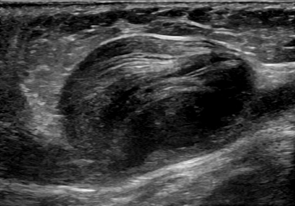 Ultrasonography of a thrombosed great saphenous vein aneurysm