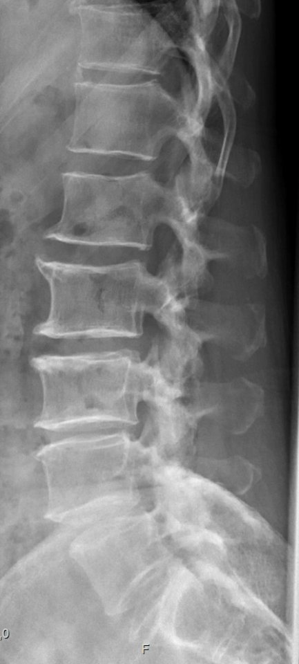 Lumbarization of S1 (lateral view)
