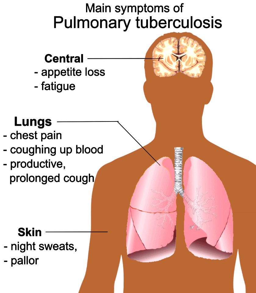 Pulmonary tuberculosis symptoms