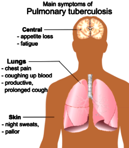Pulmonary tuberculosis symptoms photo