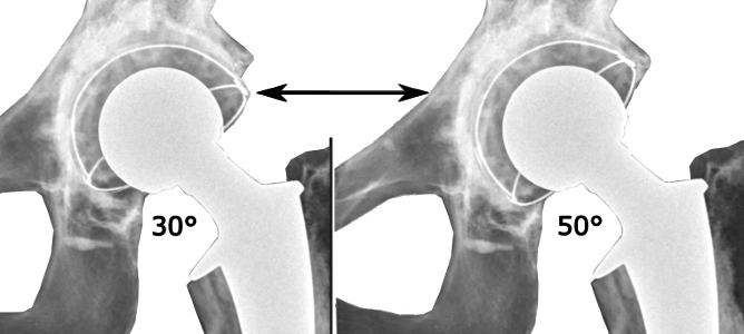 Range of acetabular inclination