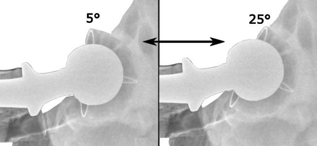 Range of acetabular anteversion