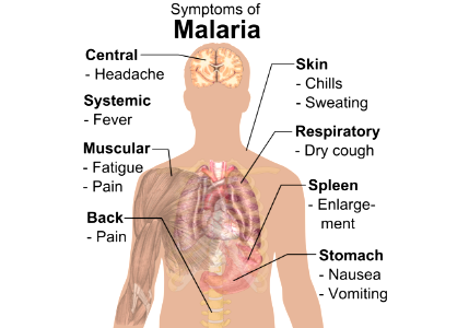 Symptoms of Malaria whitebackground
