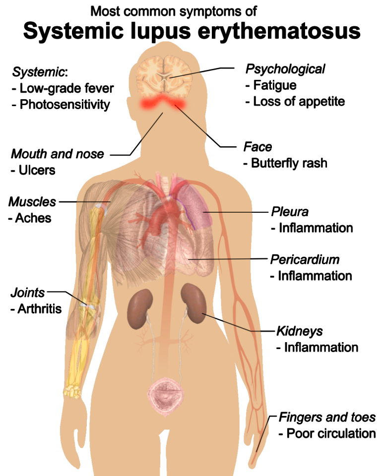 Symptoms of SLE
