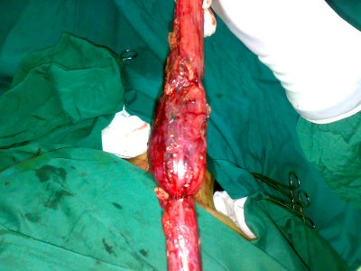 Surgical removal of the esophagus 07
