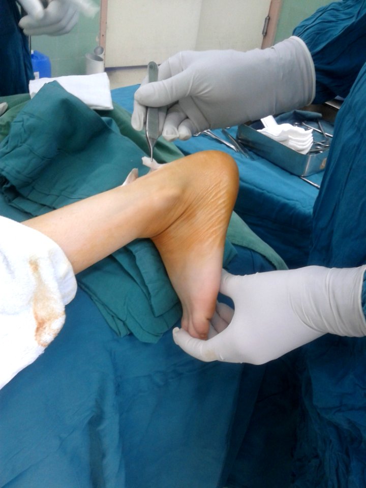 Surgery on Achilles tendon