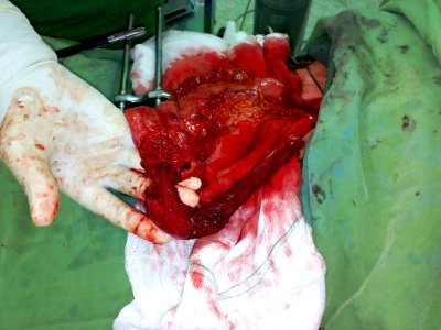 Surgical removal of the esophagus 05
