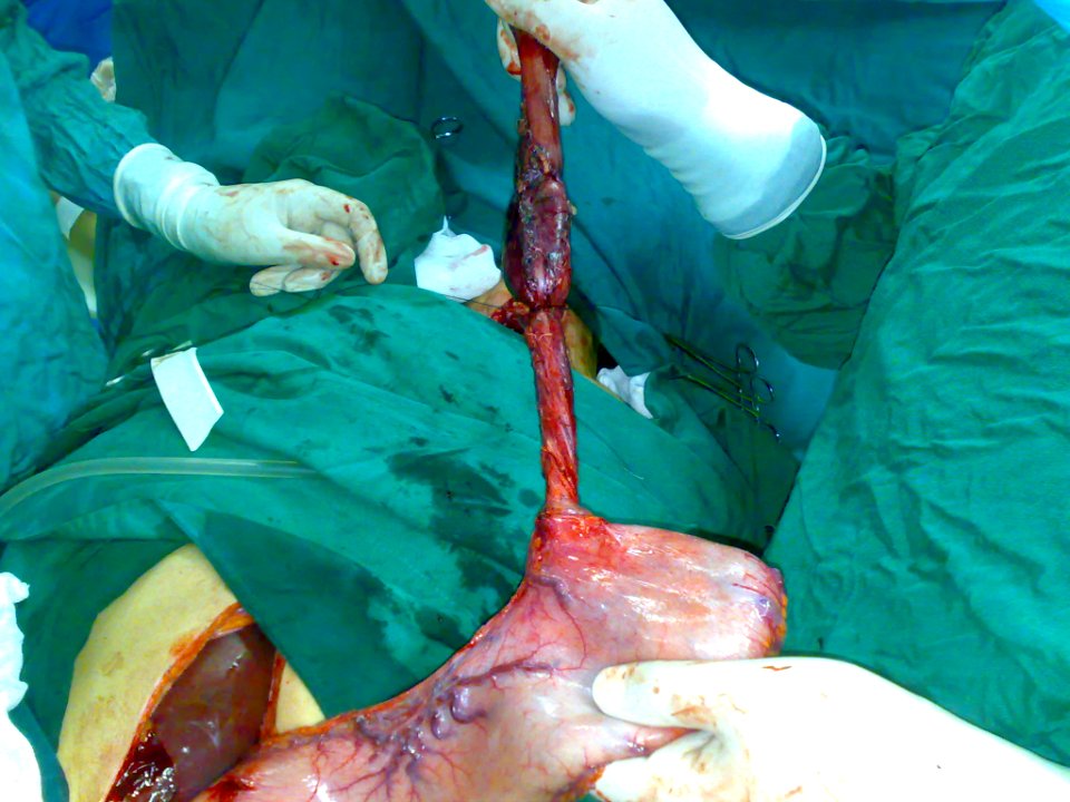 Surgical removal of the esophagus 06