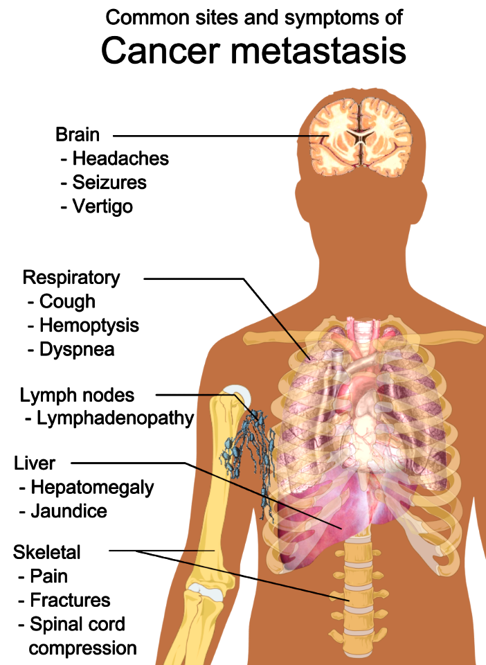 Symptoms of cancer metastasis