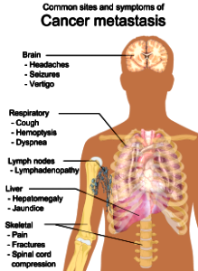 Symptoms of cancer metastasis