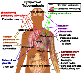 Tuberculosis symptoms