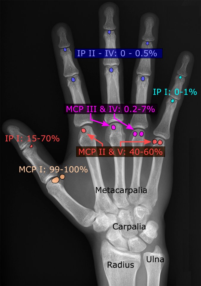 Sesamoid bones of the fingers - la