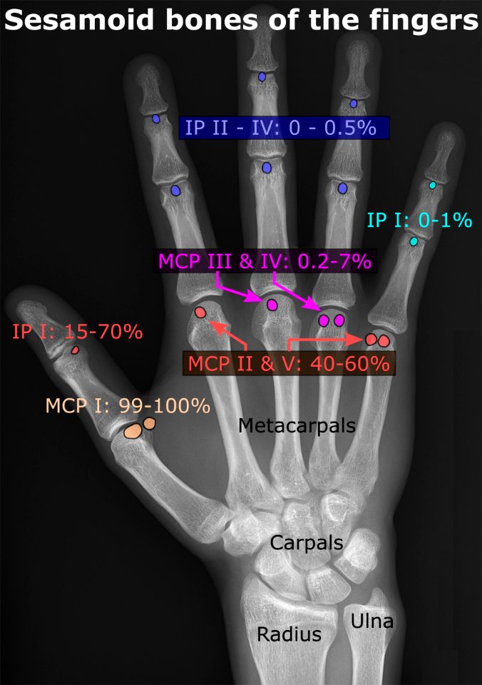 Sesamoid bones of the fingers photo