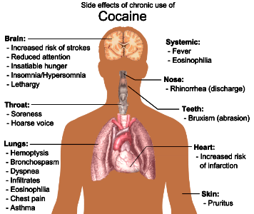 Side effects of chronic use of Cocaine