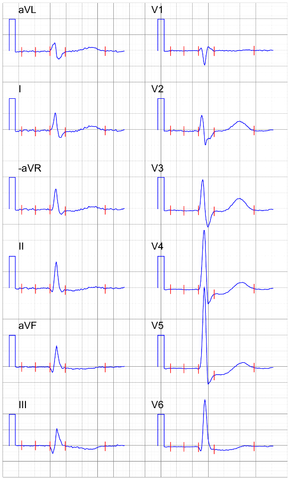 Signal-averaged ECG with digoxin