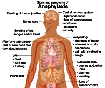 Signs and symptoms of anaphylaxis photo