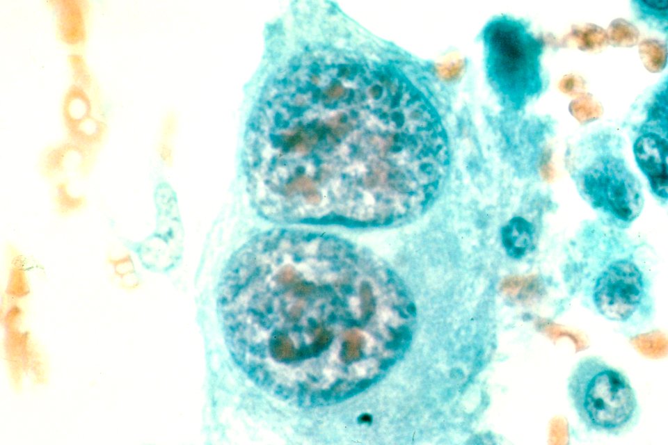 Osteosarcoma (bone cancer)