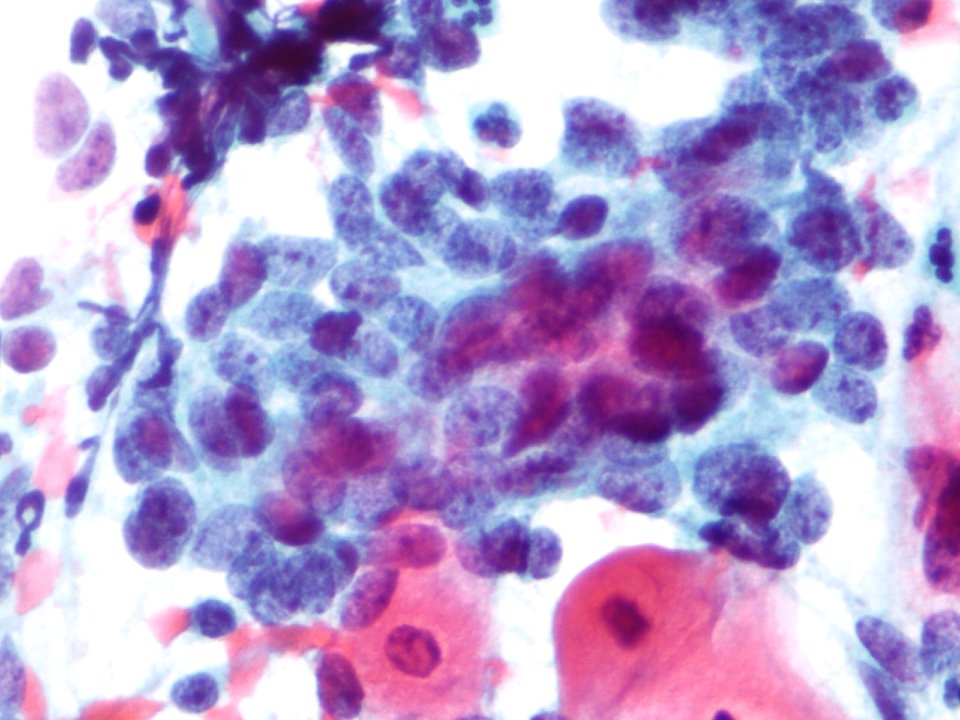Células glandulares atípicas (adenocarcinoma de cuello uterino) (9454838847)