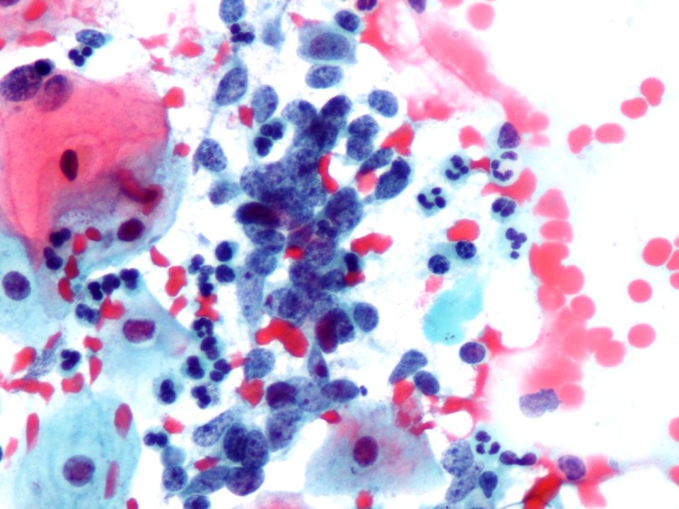 Células glandulares atípicas (adenocarcinoma de cuello uterino) (9454839289)