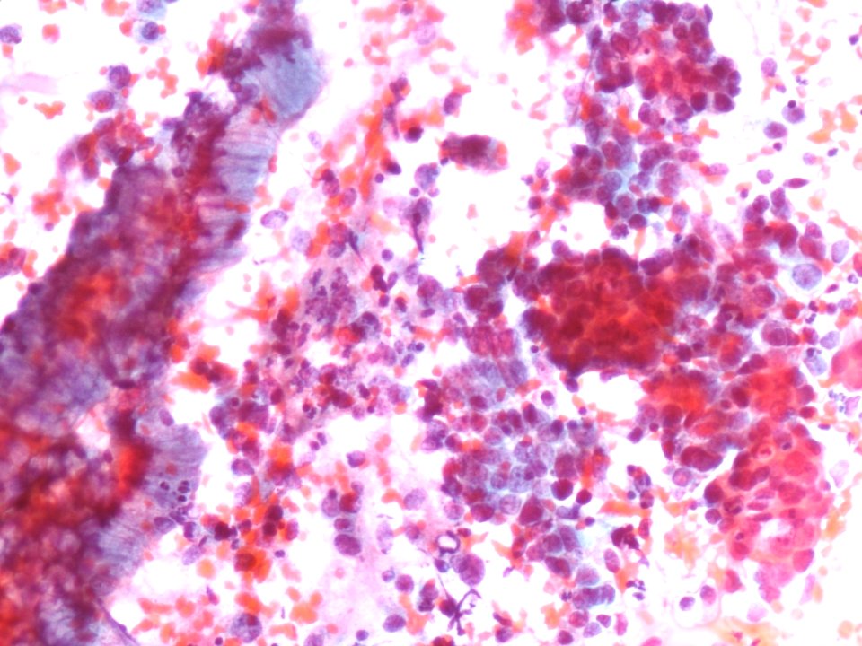 Células glandulares atípicas (adenocarcinoma de cuello uterino) (9454839435)