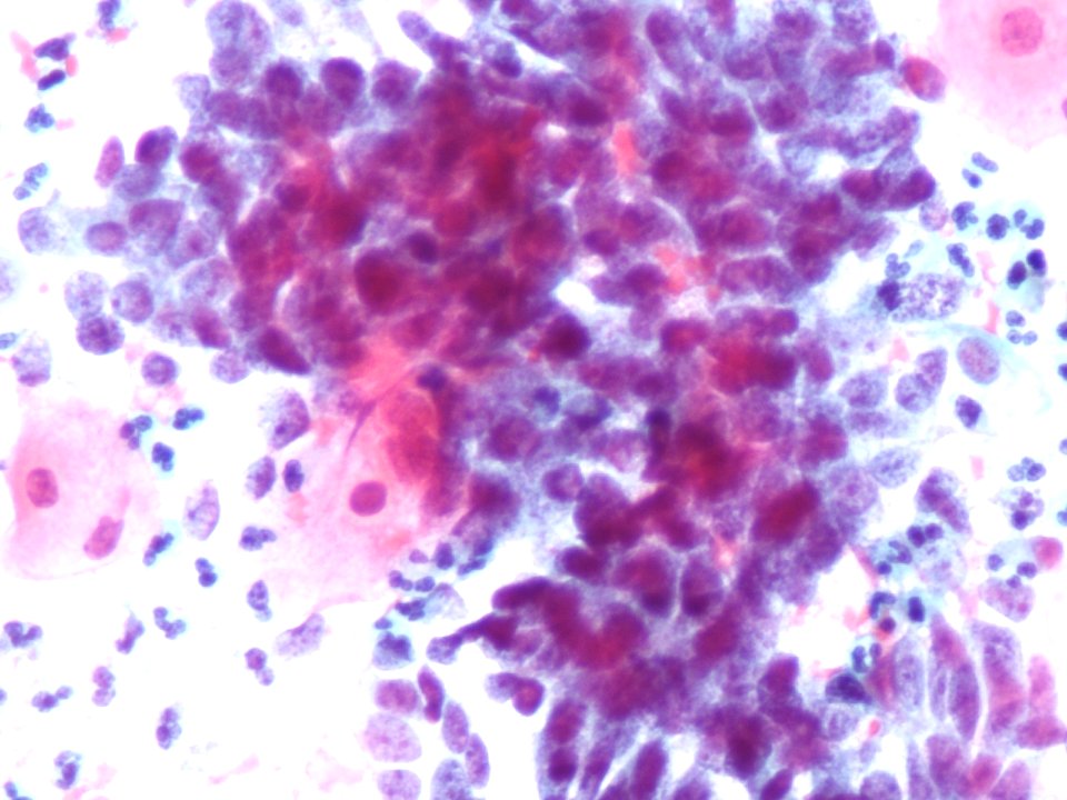 Células glandulares atípicas (adenocarcinoma de cuello uterino) (9454839657)