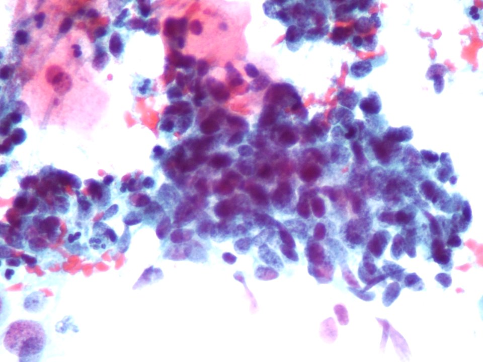 Células glandulares atípicas (adenocarcinoma de cuello uterino) (9457620128)