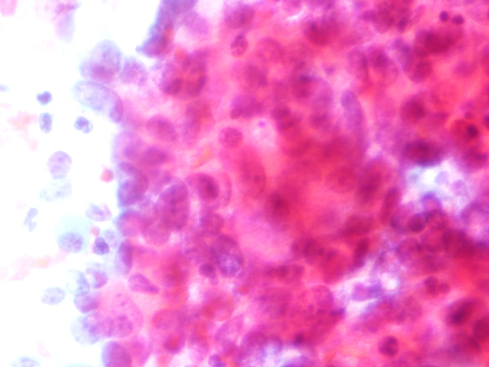 Células glandulares atípicas (adenocarcinoma de cuello uterino) (9457620362)