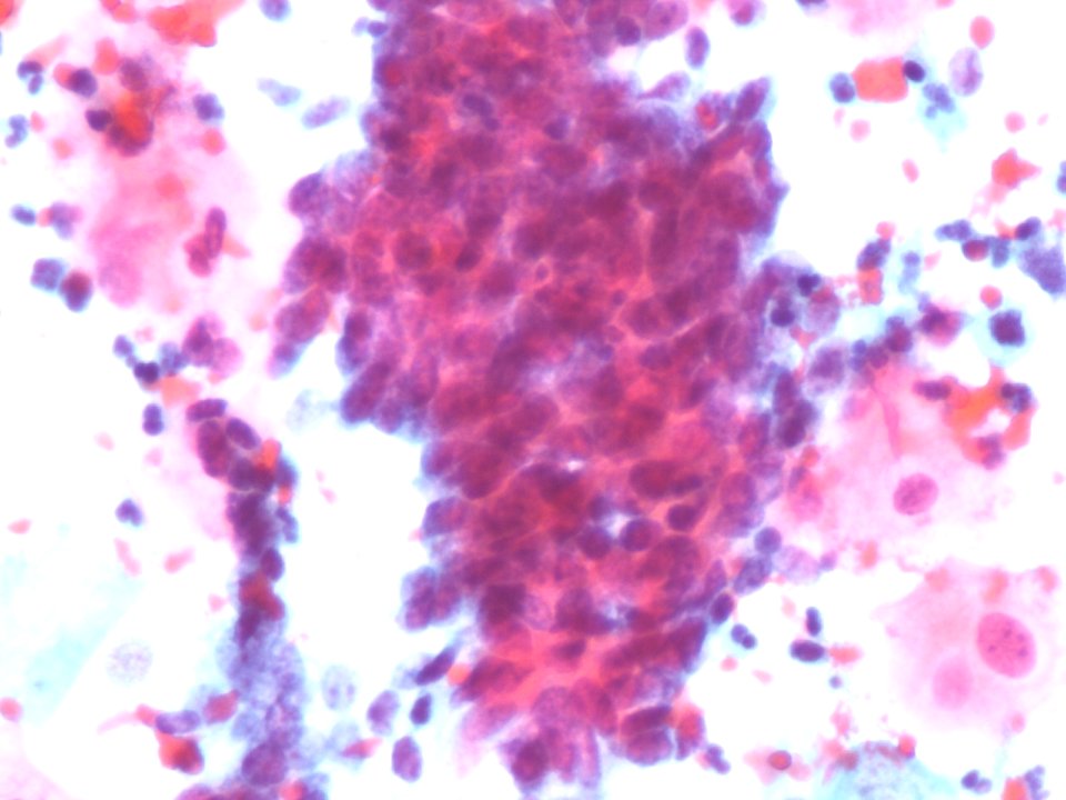 Células glandulares atípicas (adenocarcinoma de cuello uterino) (9457620456)
