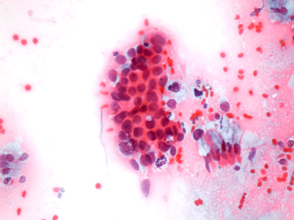 Células glandulares atípicas (adenocarcinoma de cuello uterino) (9457620656)
