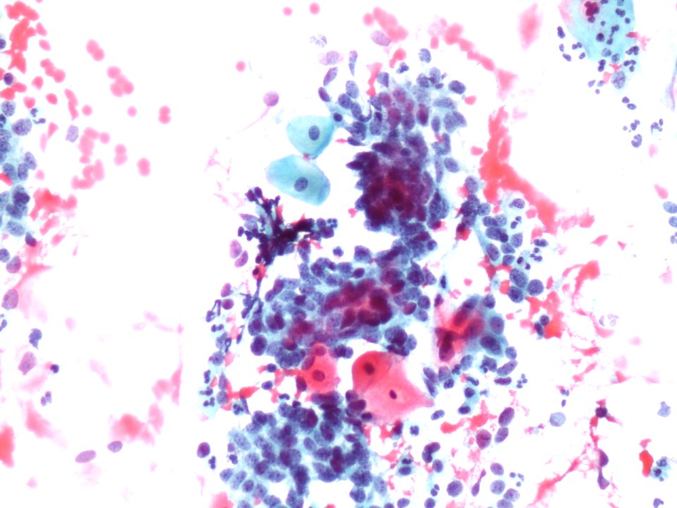 Células glandulares atípicas (adenocarcinoma de cuello uterino) (9454838829)