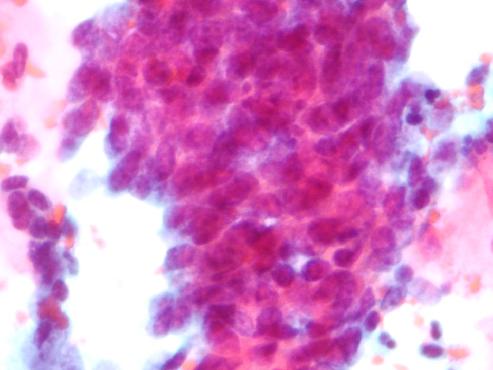 Células glandulares atípicas (adenocarcinoma de cuello uterino) (9454839275)