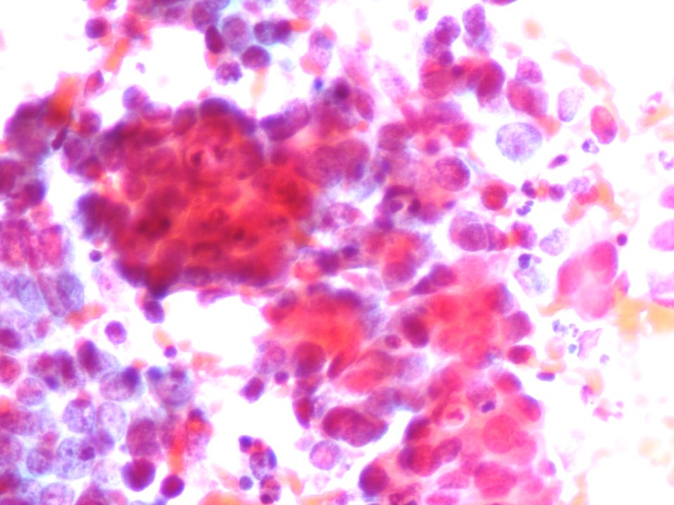 Células glandulares atípicas (adenocarcinoma de cuello uterino) (9454839403)