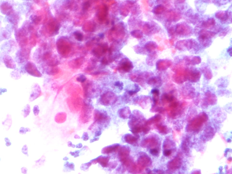Células glandulares atípicas (adenocarcinoma de cuello uterino) (9454839555)