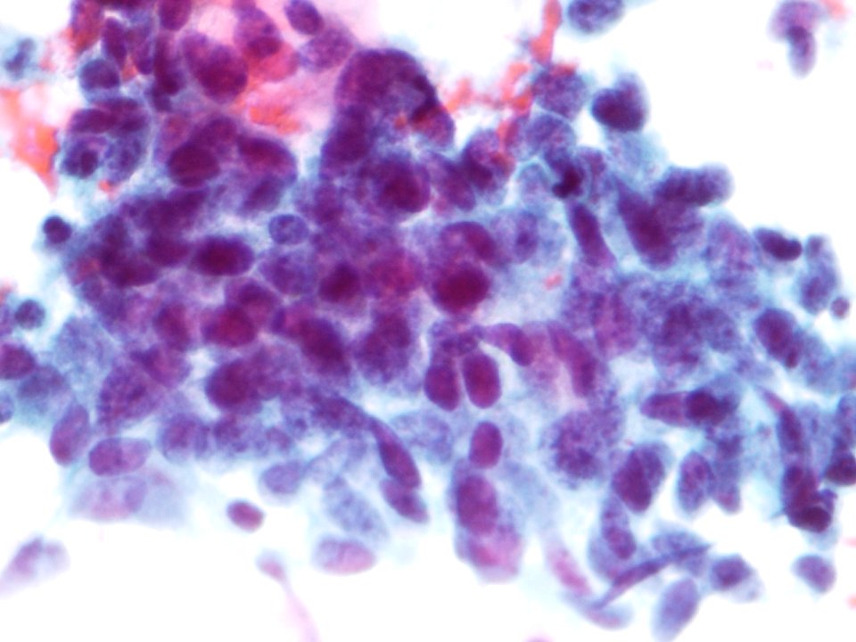 Células glandulares atípicas (adenocarcinoma de cuello uterino) (9457620092)