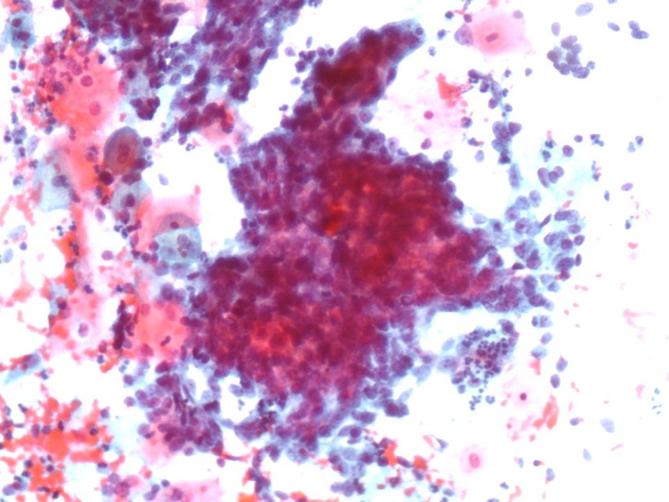 Células glandulares atípicas (adenocarcinoma de cuello uterino) (9454839111)