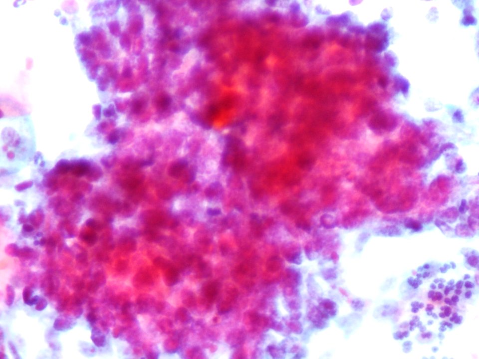 Células glandulares atípicas (adenocarcinoma de cuello uterino) (9457620244)