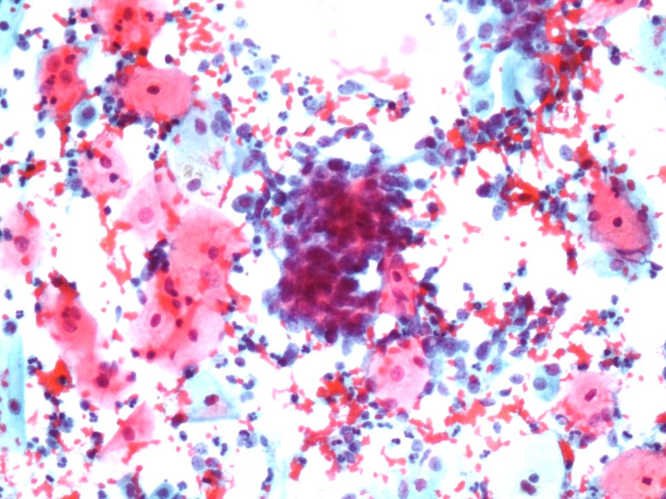 Células glandulares atípicas (adenocarcinoma de cuello uterino) (9454839401)