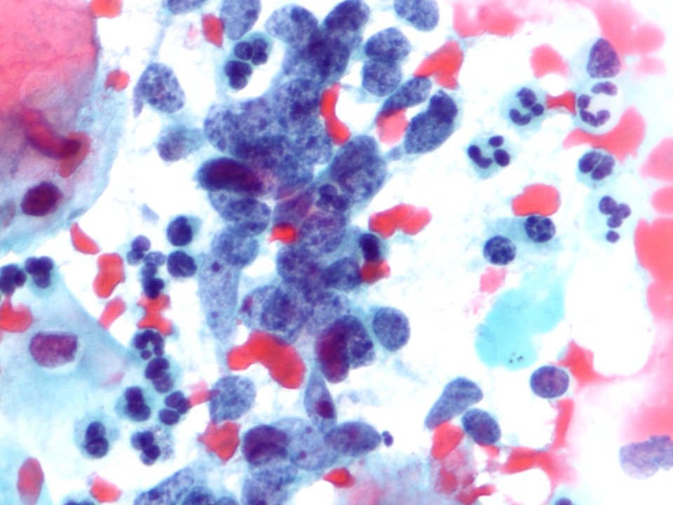 Células glandulares atípicas (adenocarcinoma de cuello uterino) (9457620412)