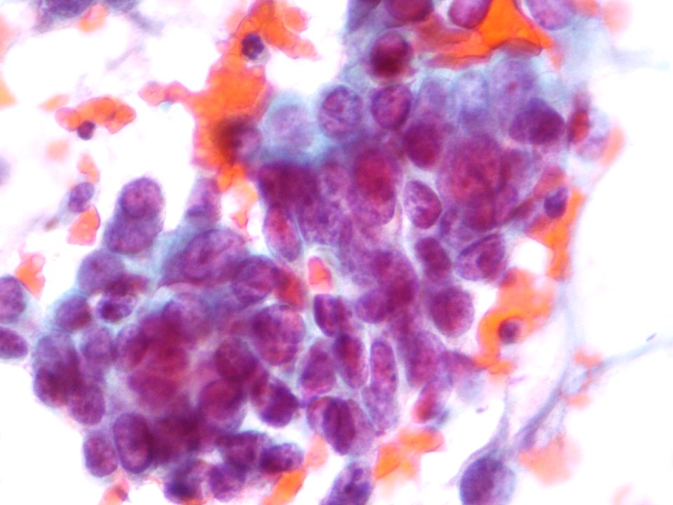 Células glandulares atípicas (adenocarcinoma de cuello uterino) (9454839535)