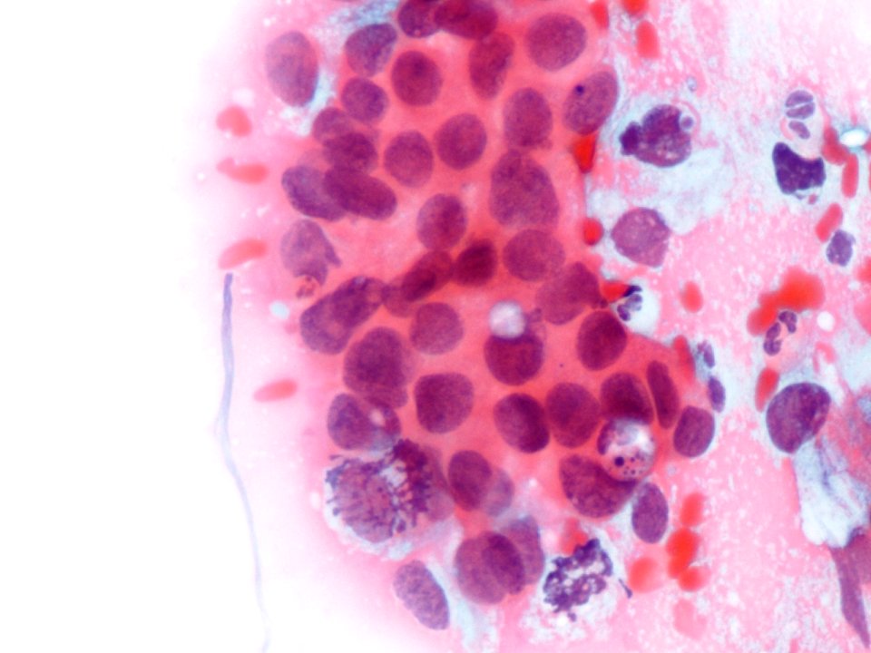 Células glandulares atípicas (adenocarcinoma de cuello uterino) (9457620654)