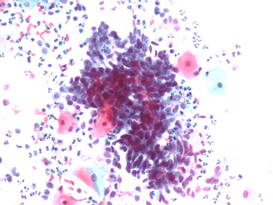 Células glandulares atípicas (adenocarcinoma de cuello uterino) (9457620046)