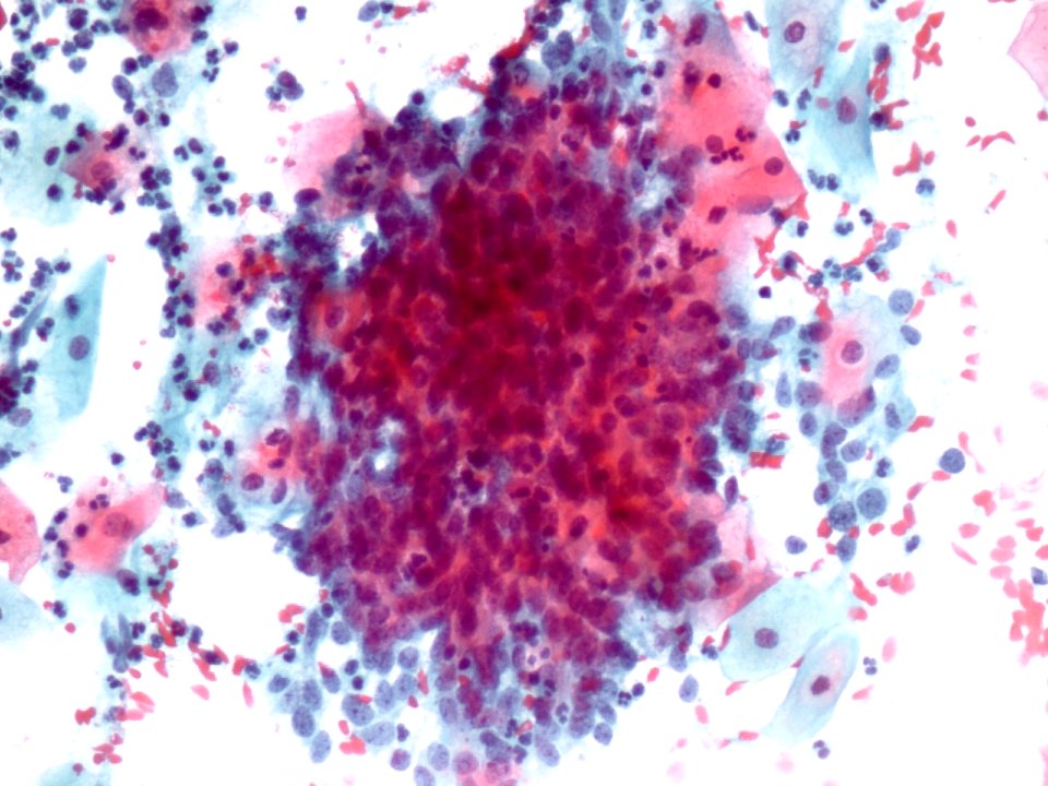 Células glandulares atípicas (adenocarcinoma de cuello uterino) (9457620202)