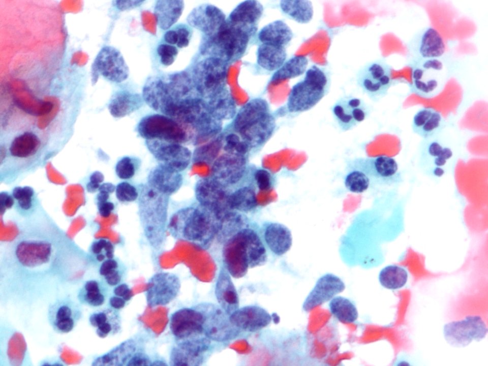 Células glandulares atípicas (adenocarcinoma de cuello uterino) (9457620406)
