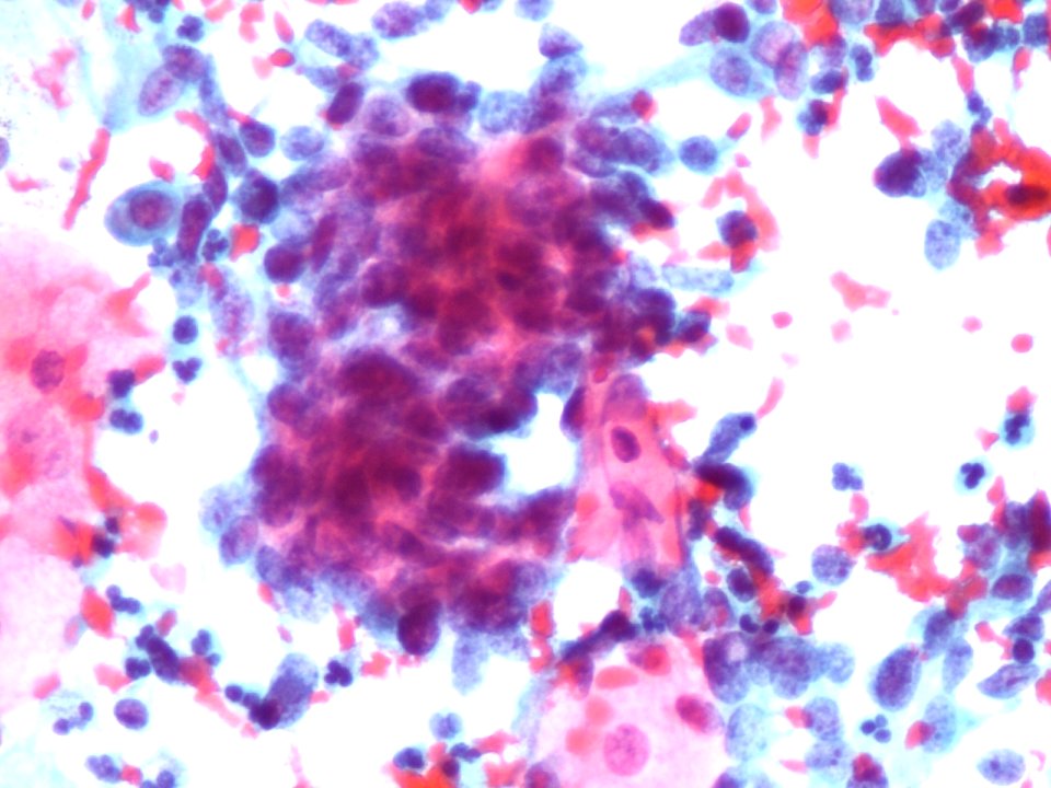 Células glandulares atípicas (adenocarcinoma de cuello uterino) (9457620516)