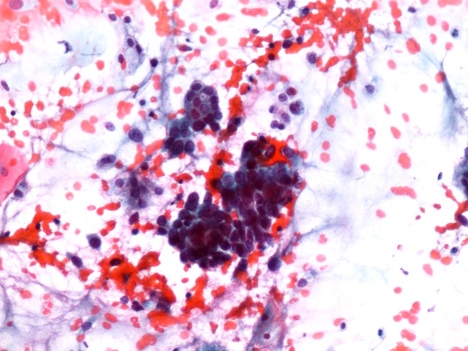 Células glandulares atípicas (adenocarcinoma de cuello uterino) (9457620732)