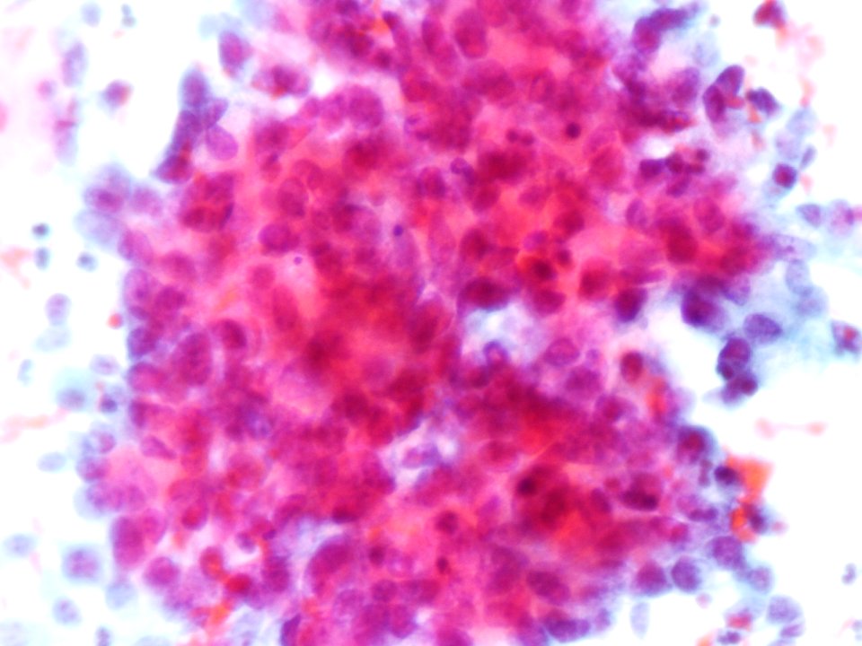 Células glandulares atípicas (adenocarcinoma de cuello uterino) (9454839109)