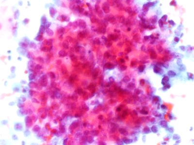 Células glandulares atípicas (adenocarcinoma de cuello uterino) (9454839109)