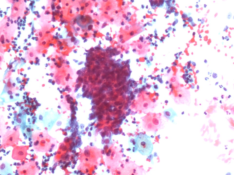 Células glandulares atípicas (adenocarcinoma de cuello uterino) (9454839339)