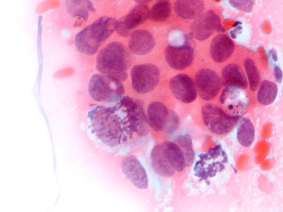 Células glandulares atípicas (adenocarcinoma de cuello uterino) (9454839463)